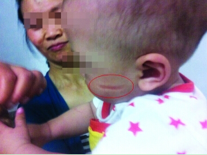 鉴定机构称新生儿脸部刀痕为四级医疗事故